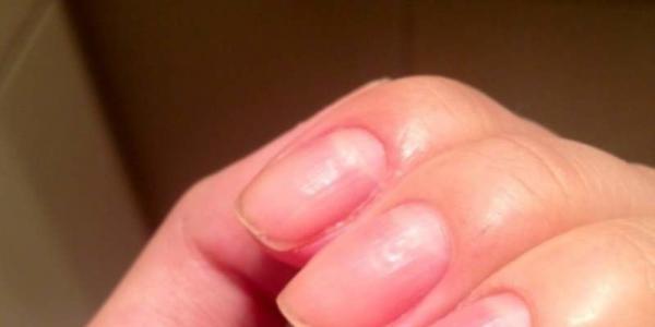 Волнистые ногти на больших пальцах рук: причины