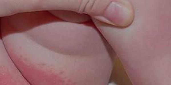Потница на лице у грудничков, новорожденных: фото, лечение